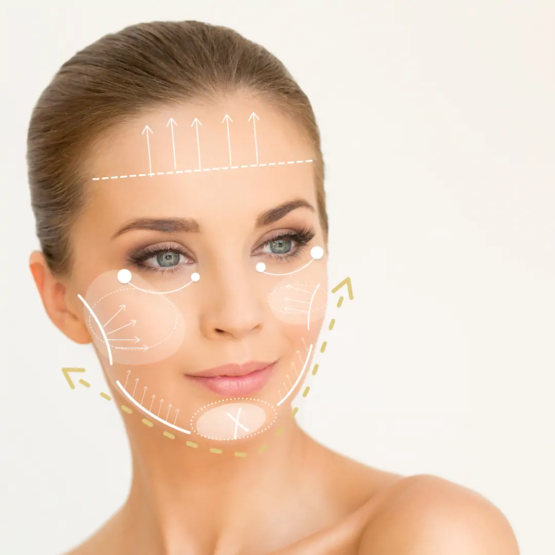 Visualización de tratamiento Full Face en rostro femenino con líneas de vectores para armonización global del tercio superior, medio e inferior. Técnica integral en Clínica Alcolea
