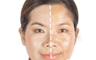 Melasma:  Un desafío