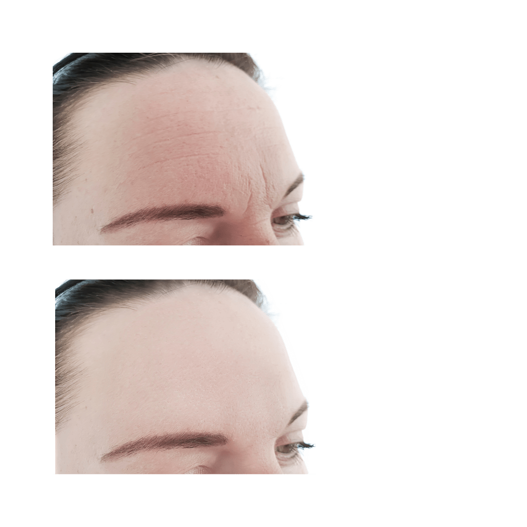 Arrugas dinámicas de expresión antes y después del tratamiento