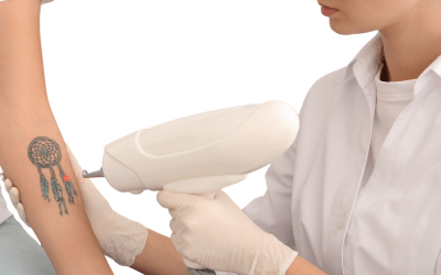 Eliminación de tatuajes