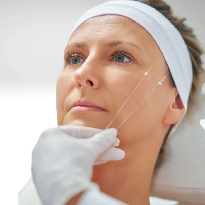 Aplicación de hilos tensores con conos en mejilla de paciente madura en Clínica Alcolea. Técnica de lifting facial no quirúrgico para redefinir el óvalo facial