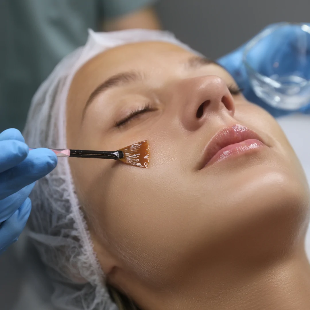 Aplicación de peeling químico facial con brocha en paciente relajada. Tratamiento para renovar la piel y mejorar textura, manchas y luminosidad en Clínica Alcolea