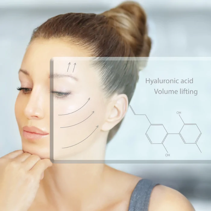 Visualización conceptual de tratamiento con ácido hialurónico para lifting de volumen facial. Mujer con esquema de vectores de elevación en pómulos y sien