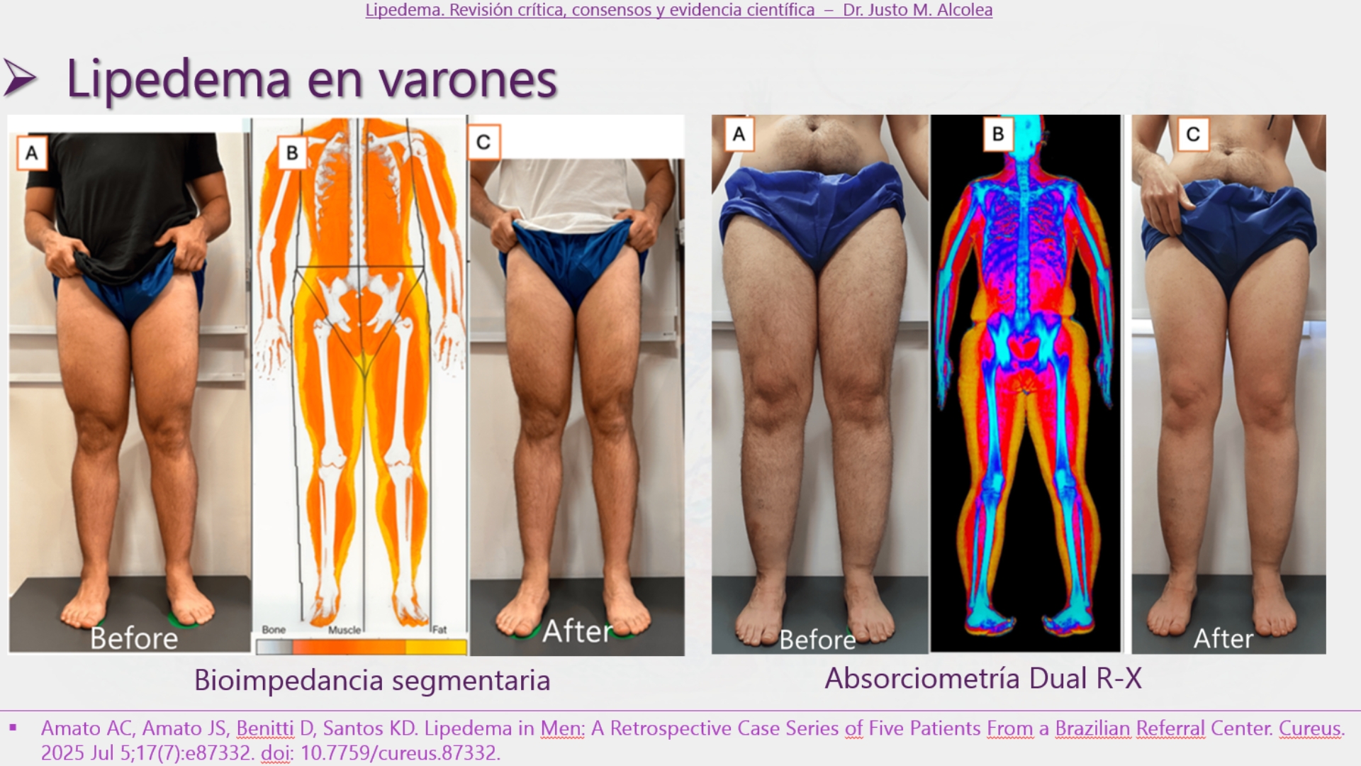 Evaluación clínica del lipedema en varones mediante bioimpedancia segmentaria y absorciometría DXA comparando distribución grasa corporal