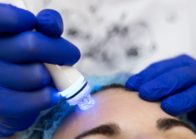 Aplicador Aquapeel de Aquapure realizando una limpieza facial en la frente.